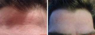 Anti Aging and Anti Wrinkle Treatment Before and After Pictures